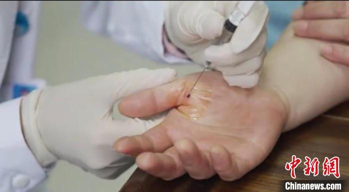 嘉善群眾體驗(yàn)小針刀。　嘉善統(tǒng)戰(zhàn) 供圖