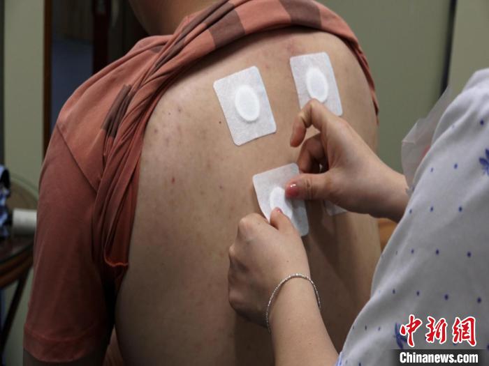 圖為醫(yī)生正在為民眾貼“三伏貼”?！√莆登?攝